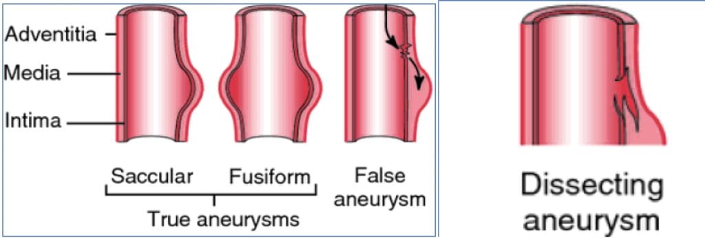 Aneurysm Classification