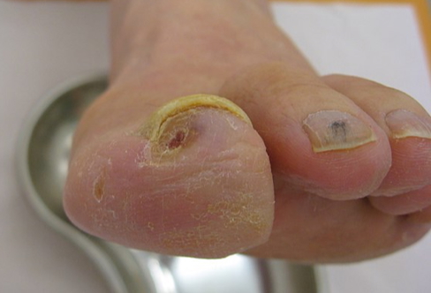 Chronic arterial ulcer - toe