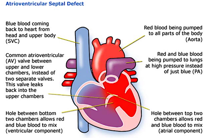 Atrioventricular Septal Defect - Downs Congenital Heart Defect