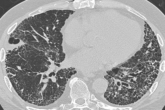 Atypical pneumonia CT