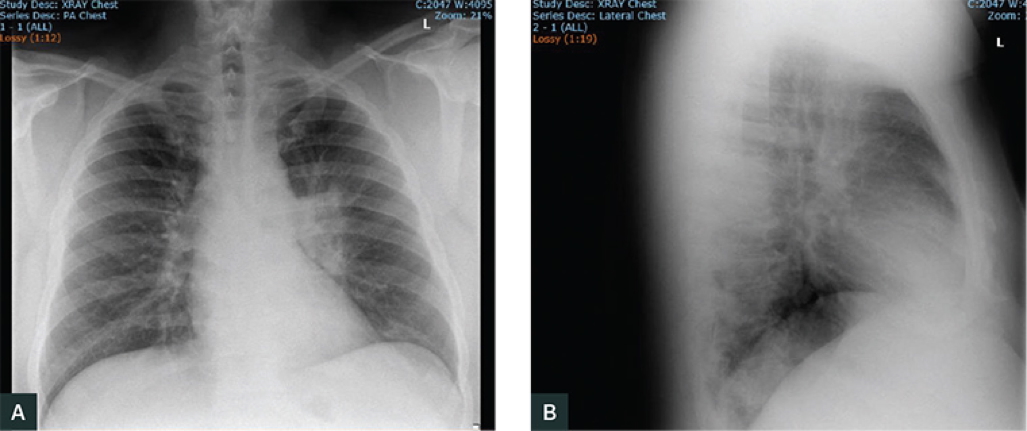 Atypical pneumonias CXR