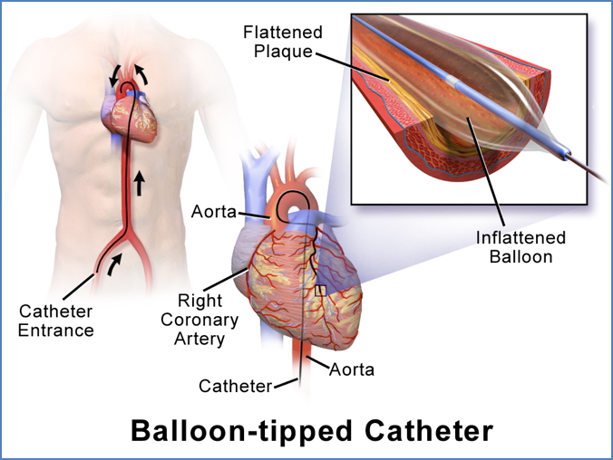 Balloon Angioplasty in atherosclerosis treatment