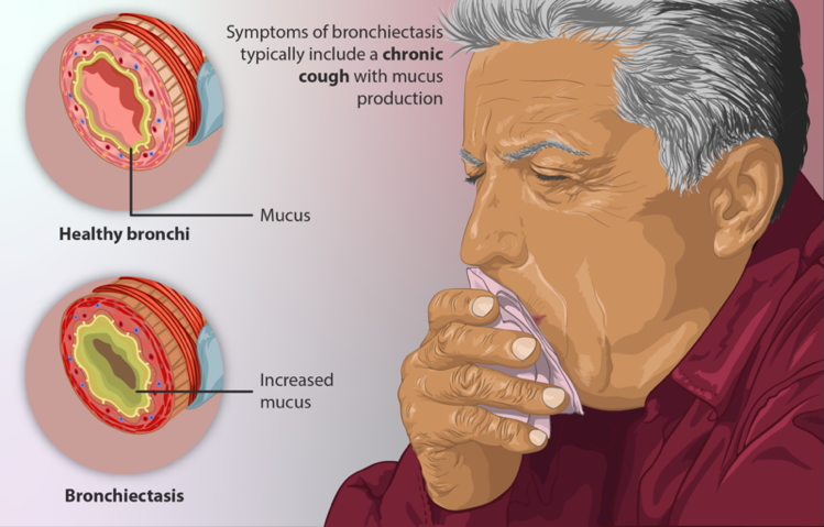 bronchiectasis