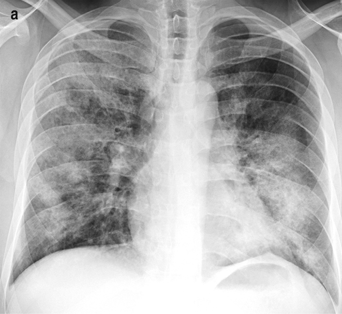 Bronchopneumonia CXR