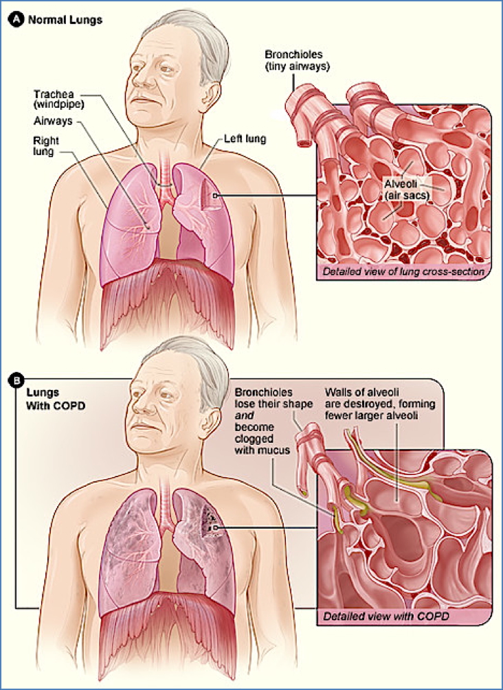 COPD Pathophysiology