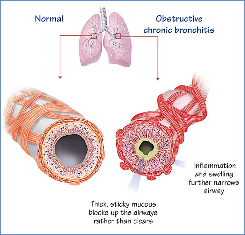 Chronic Bronchitis