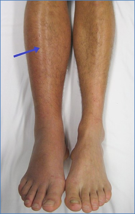 DVT Clinical Photo