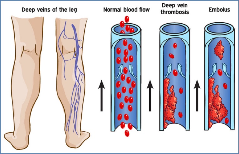 Deep venous thromboembolism (DVT)