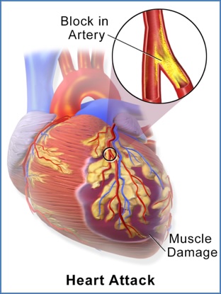 ischaemic heart disease