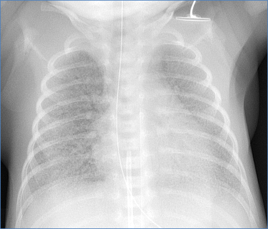 Infant respiratory distress syndrome CXR