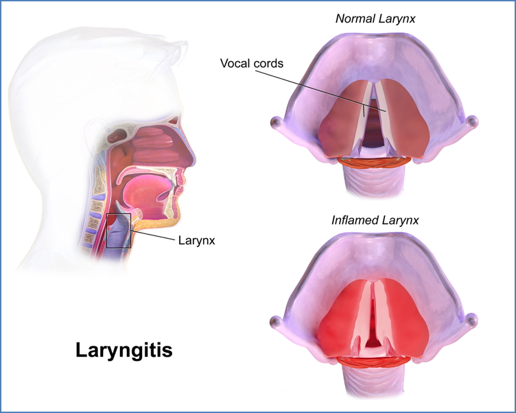 Laryngitis