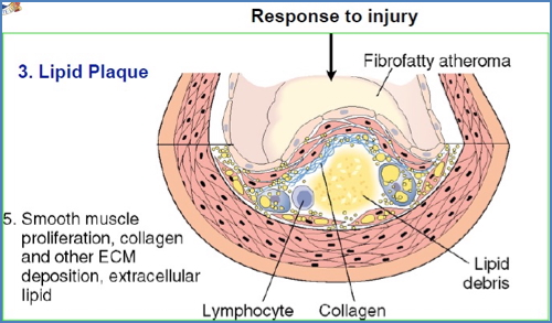 Lipid plaque formation in atherosclerosis