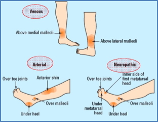 Locations of Venous, Arterial & Neuropathic chronic skin Ulcers