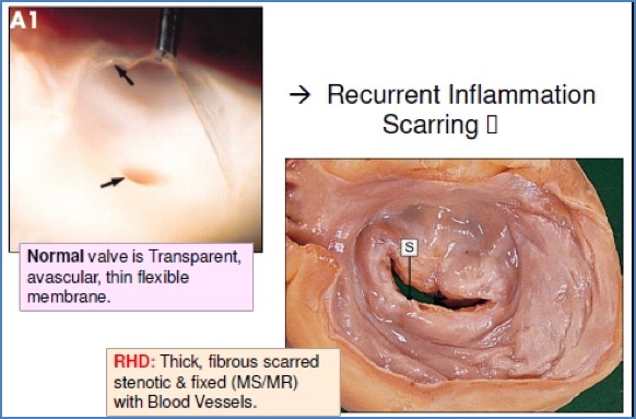 Mitral stenosis from rheumatic heart disease