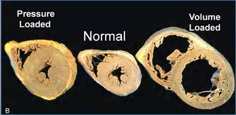 Myocardial Hypertrophy in Heart Failure