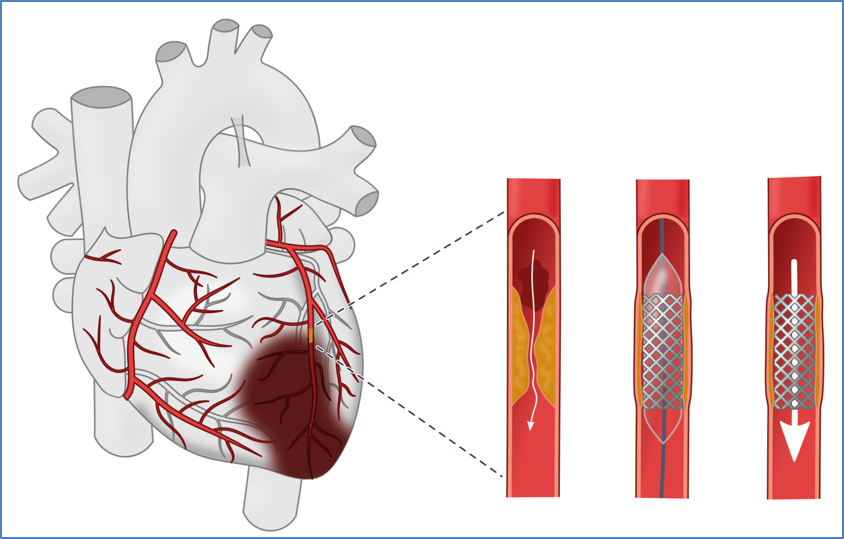 Myocarial Revascularisation in Acute Coronary Syndromes