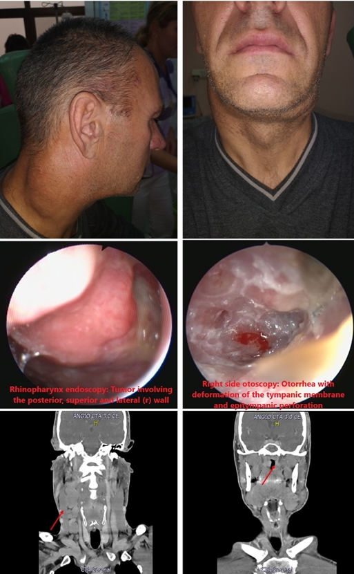 Nasal Tumours - Nasopharyngeal Carcinoma