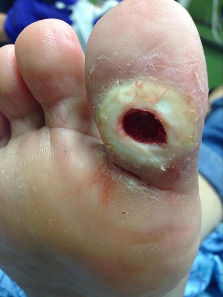 Neuropathic Ulcer