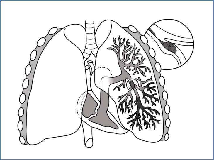 Pulmonary thromboembolism (PE) Diagram