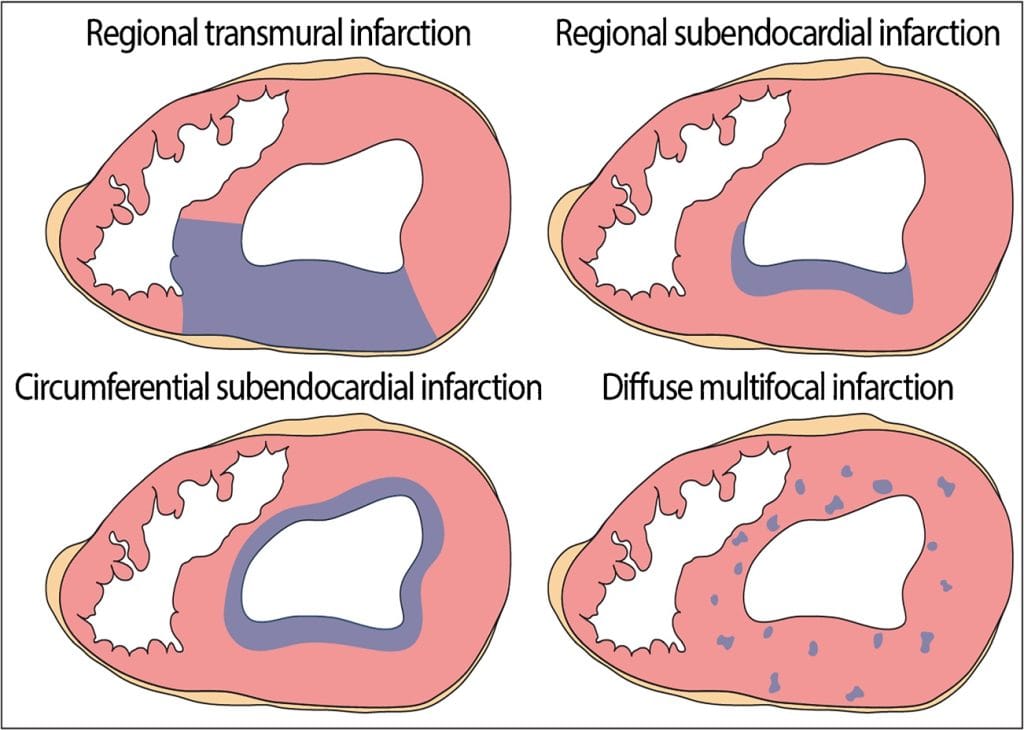 Patterns of Myocardial Ischaemia
