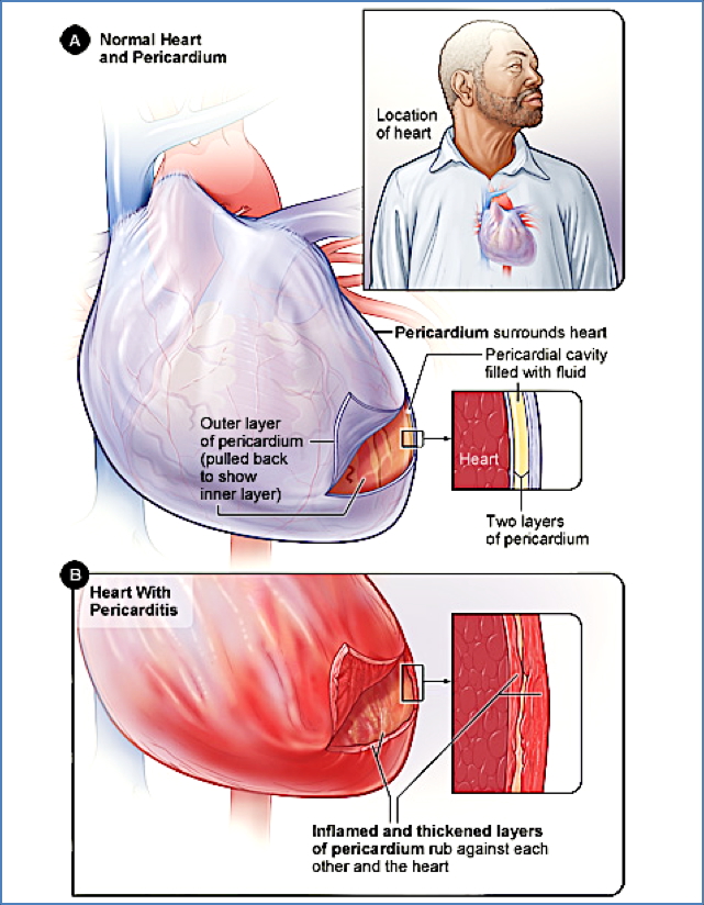 Pericarditis Diagram