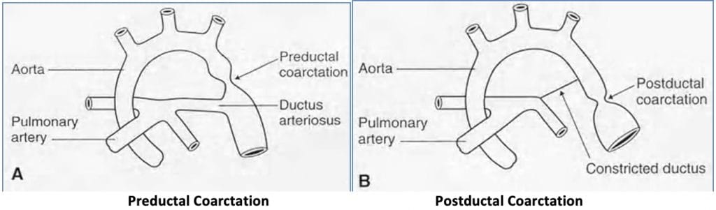 Coarctation of the Aorta