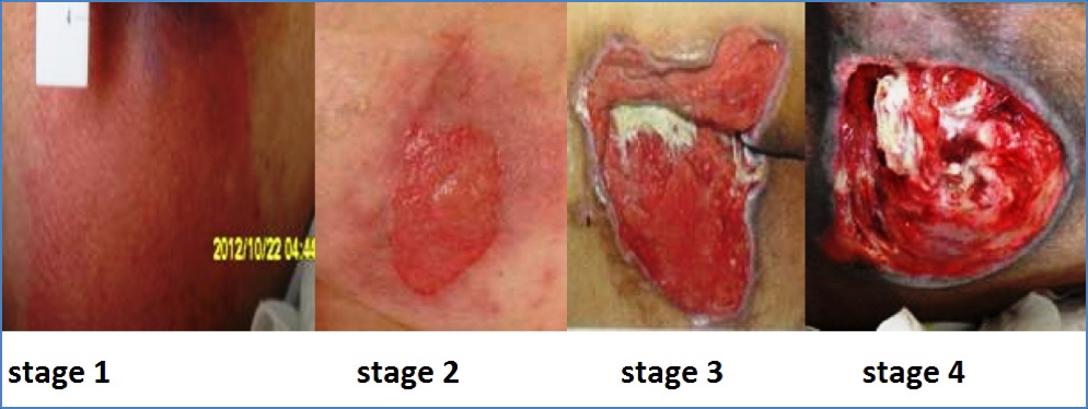 Chronic skin Ulcer stages