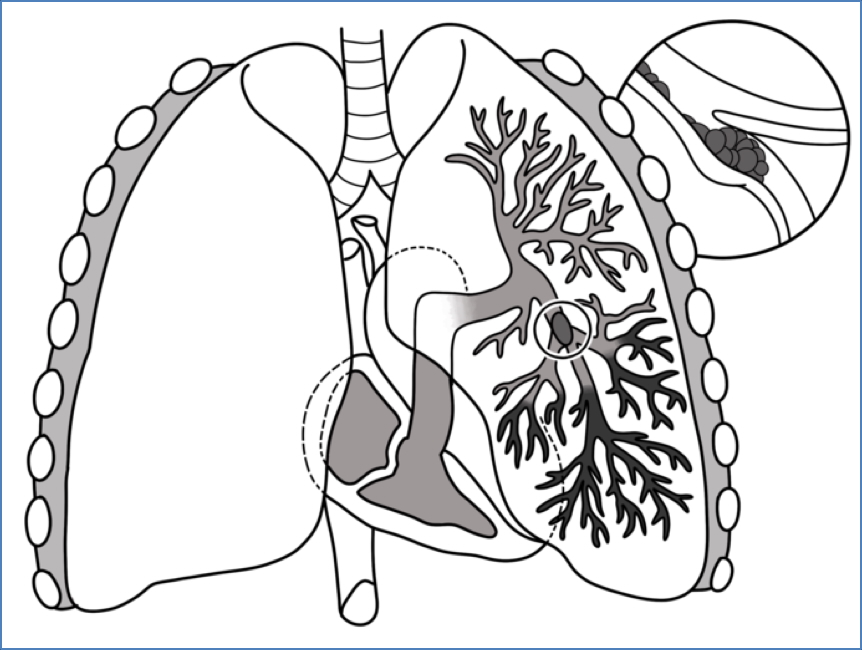 Pulmonary embolus
