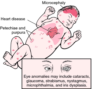 congenital rubella complications
