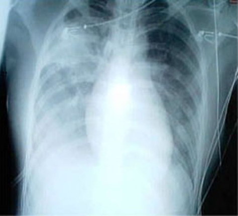 Severe Acute Respiratory Syndrome (SARS) CXR
