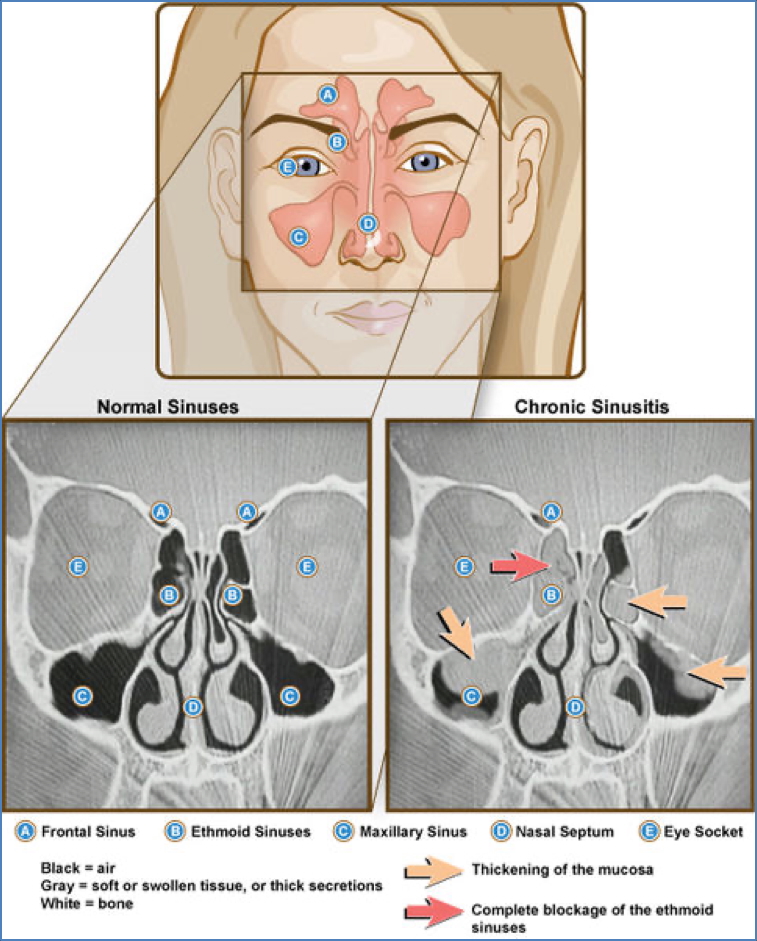 Sinusitis - normal vs chronic
