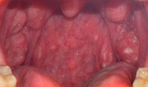 Strep Throat - leading cause of rheumatic heart disease