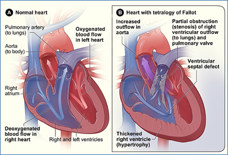 Tetralogy of Fallot - congenital heart defect