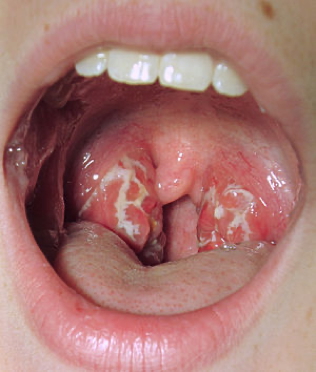 Strep Tonsillitis