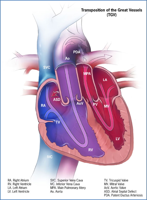 Transposition of the Great Vessels