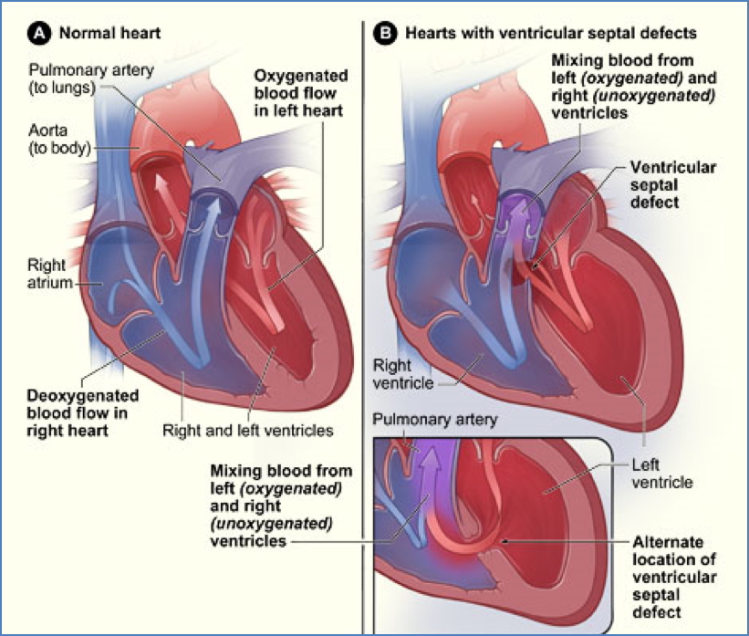 Ventricular Septal Defect