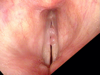 laryngeal tumours - Vocal cord nodules