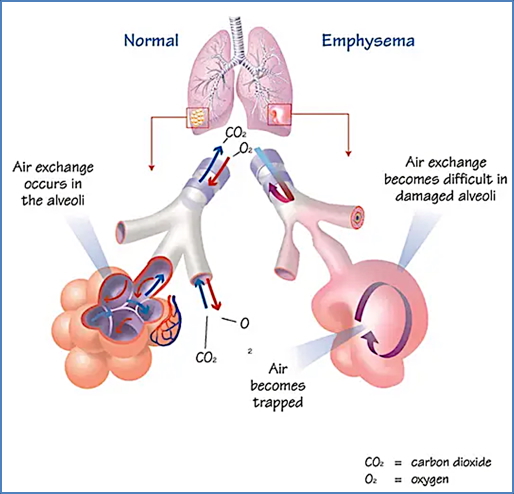 COPD Emphysema pathophysiolgy