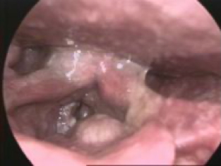 Laryngeal Tumours - laryngeal carcinoma