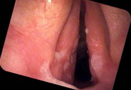 chronic laryngitis