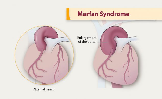 Marfan Syndrome Congenital Heart Defects
