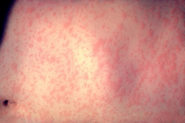 measles - rash