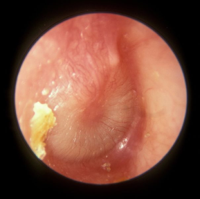 Acute Otitis Media - otoscopy