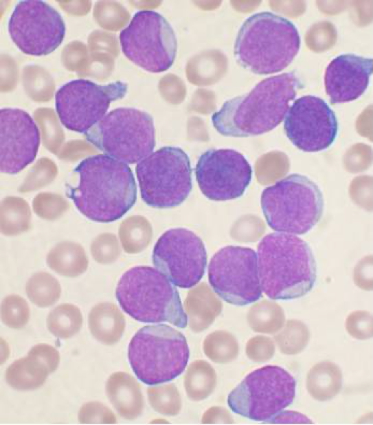 ACUTE LYMPHOBLASTIC LEUKAEMIA