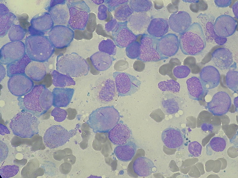 ACUTE MYELOID LEUKAEMIA