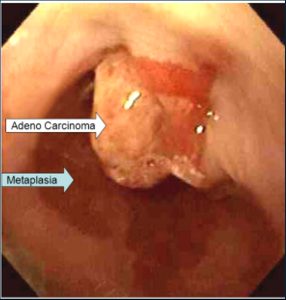 gastro-oesophageal reflux disease - ADENOCARCINOMA