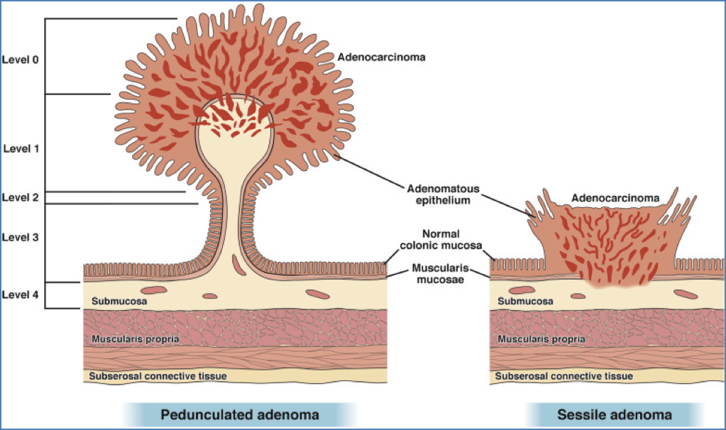 polyps & colon cancer - ADENOMAS