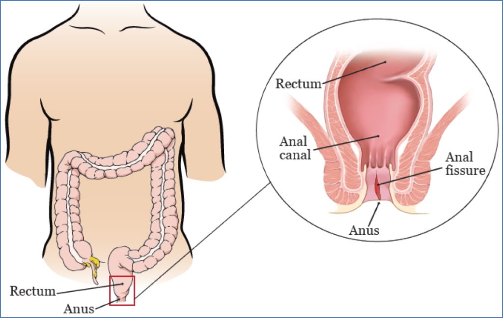 ANAL FISSURES