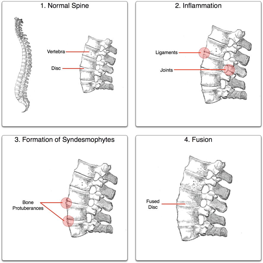 ANKYLOSING SPONDYLITIS