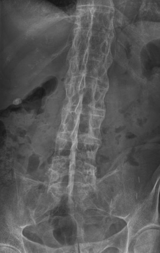 ANKYLOSING SPONDYLITIS